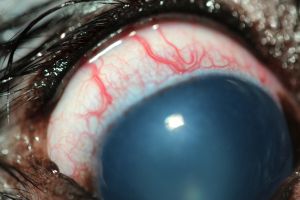 Glaukom, gestaute Gefäße und große Pupille
